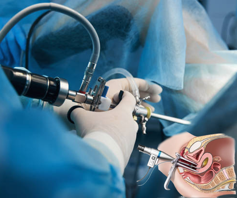 Hysteroscopy