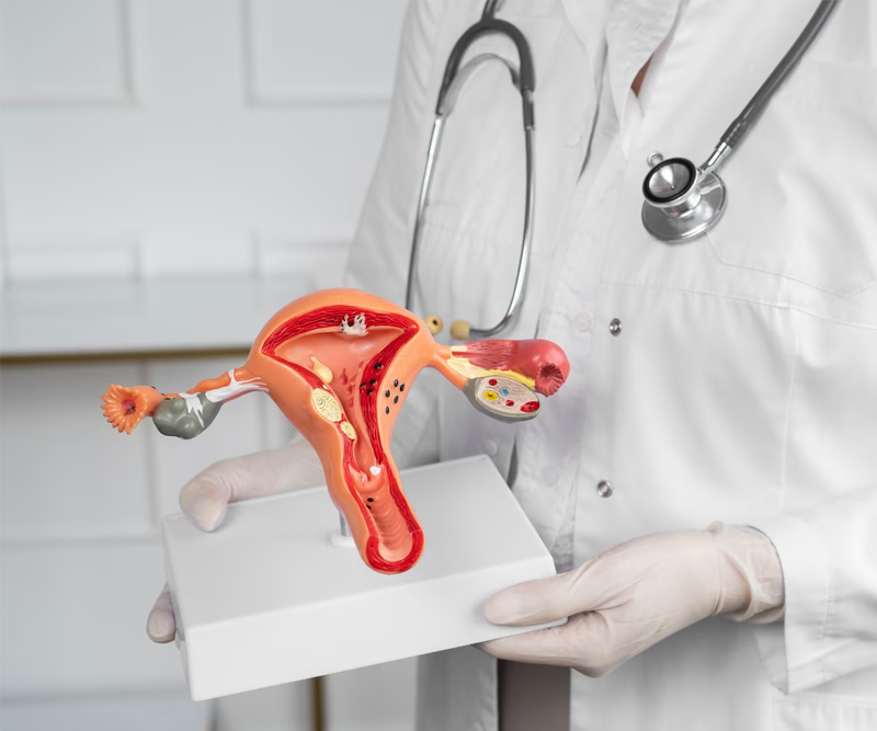 Ovarian Cysts Consultation