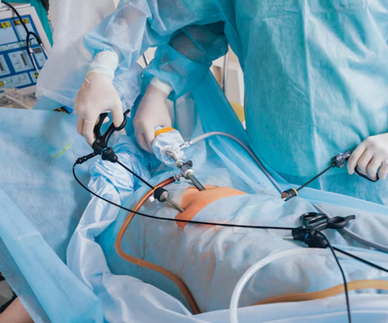 Laparoscopic Oopherectomy