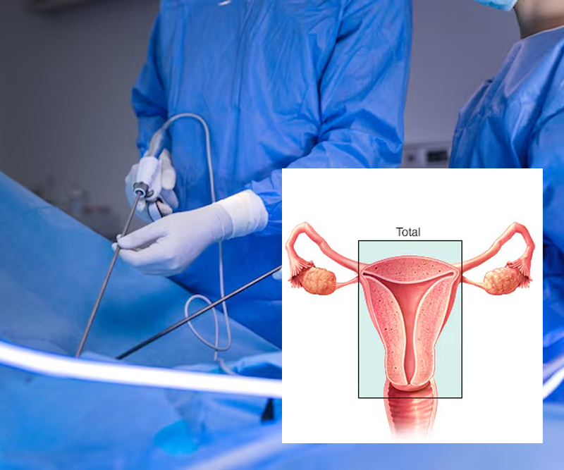 Total Abdominal Hysterectomy